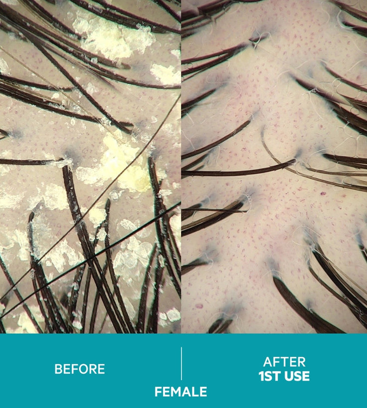Dandrene Anti-Schuppen Shampoo