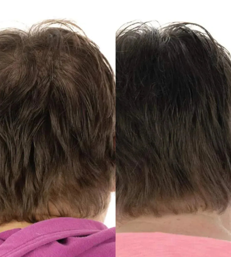 Foligain Haarwuchsbehandlung (Frau) - Hairgivers