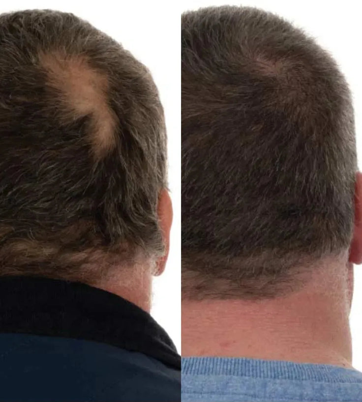 Foligain Shampoo gegen Haarausfall für Männer (236 ml) - Hairgivers