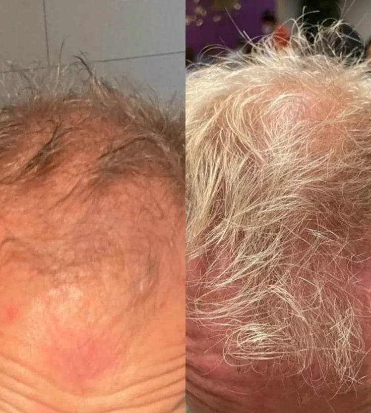 Neofollics Tabletten gegen Haarausfall - Hairgivers