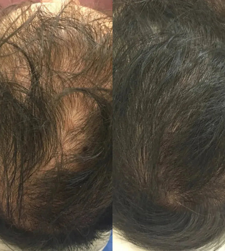 Revita Shampoo + Conditioner Kombi-Packung (205 ml) - Hairgivers