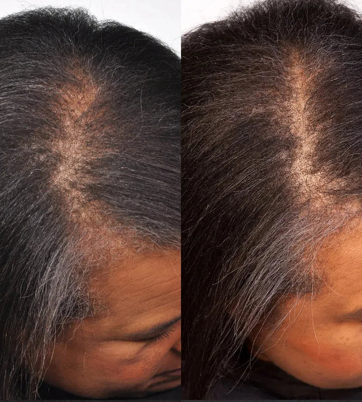 Theradome LH40 EVO Laserhelm - Hairgivers