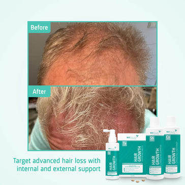 Behandlung von fortgeschrittenem erblich bedingtem Haarausfall bei Männern - Hairgivers
