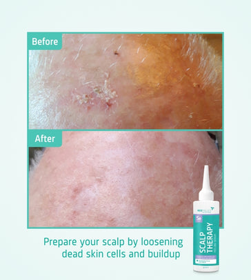 Neofollics Kopfhaut Peeling Serum Neofollics Kopfhaut Peeling Serum - Hairgivers