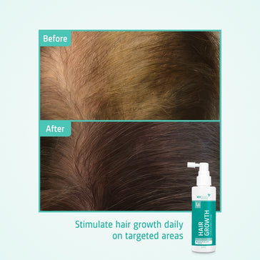 Neofollics Serum gegen Haarausfall 3-Pack (7% Neoxyl) - Hairgivers