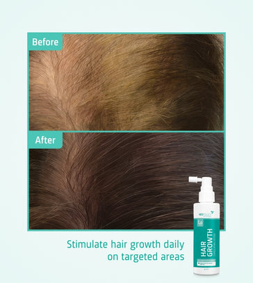 Neofollics Serum gegen Haarausfall 3-Pack (7% Neoxyl) - Hairgivers