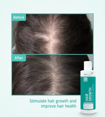 Neofollics Shampoo gegen Haarausfall 3-Pack (3x250 ml) - Hairgivers