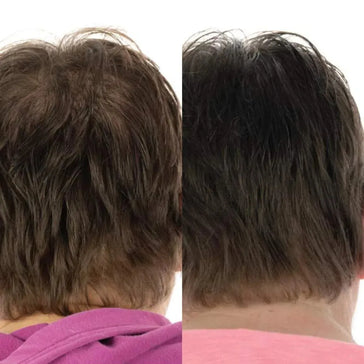 Foligain Haarwuchsbehandlung (Frau) - Hairgivers