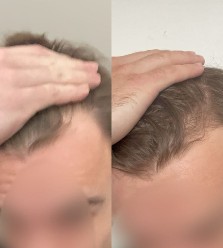 Scandinavian Biolabs Bio-Pilixin Hairline Booster
