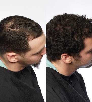 Theradome LH80 PRO Laserhelm Theradome LH80 PRO Laserhelm - Hairgivers