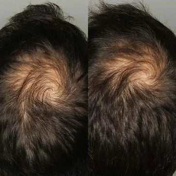 Viviscal Haarwachstums-Tabletten für Männer (3 Monate) - Hairgivers