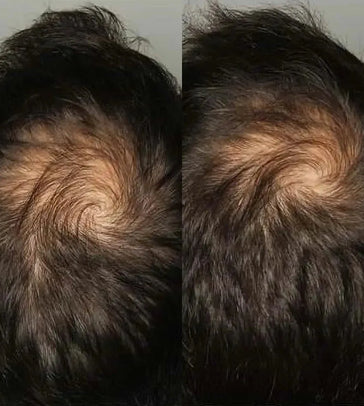 Viviscal Haarwachstums-Tabletten für Männer (3 Monate) - Hairgivers